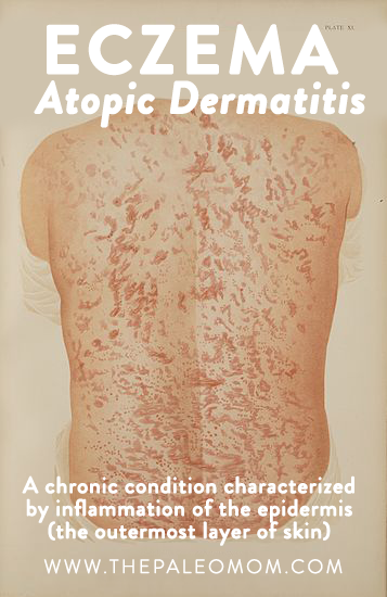 The-Paleo-Mom-4-Tips-to-Combat-Eczema-Atopic-Dermatitis